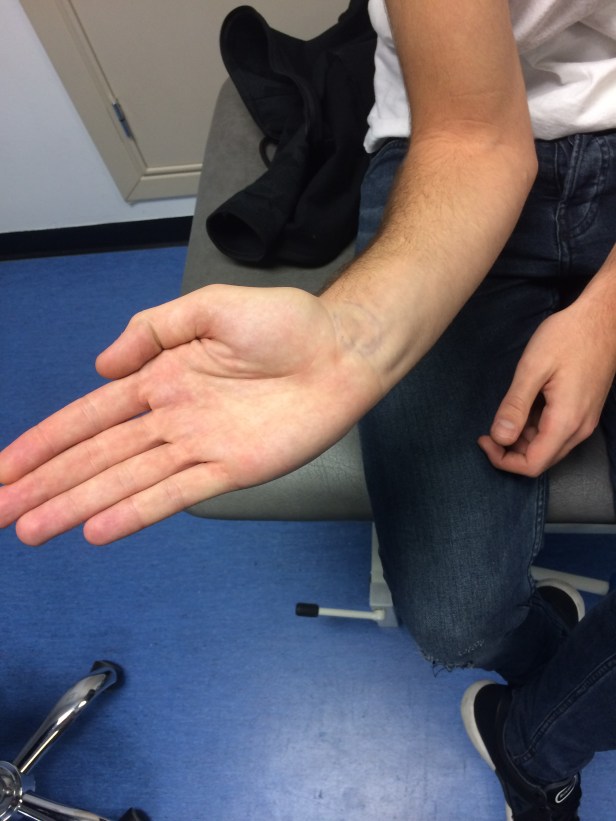 ext-radial-corto-del-carpo-solo